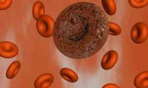 Что такое тромбоцитоз? Причины и симптомы