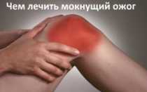 Лечение мокнущей раны после ожога