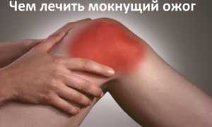 Лечение мокнущей раны после ожога