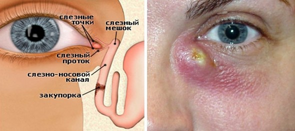 Симптом дакриоцистита 1