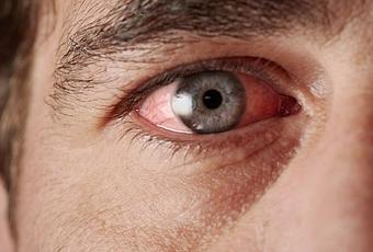 Покраснение конъюнктивы