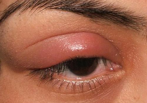 Отек верхнего правого века