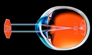 Форма глазного яблока при близорукости