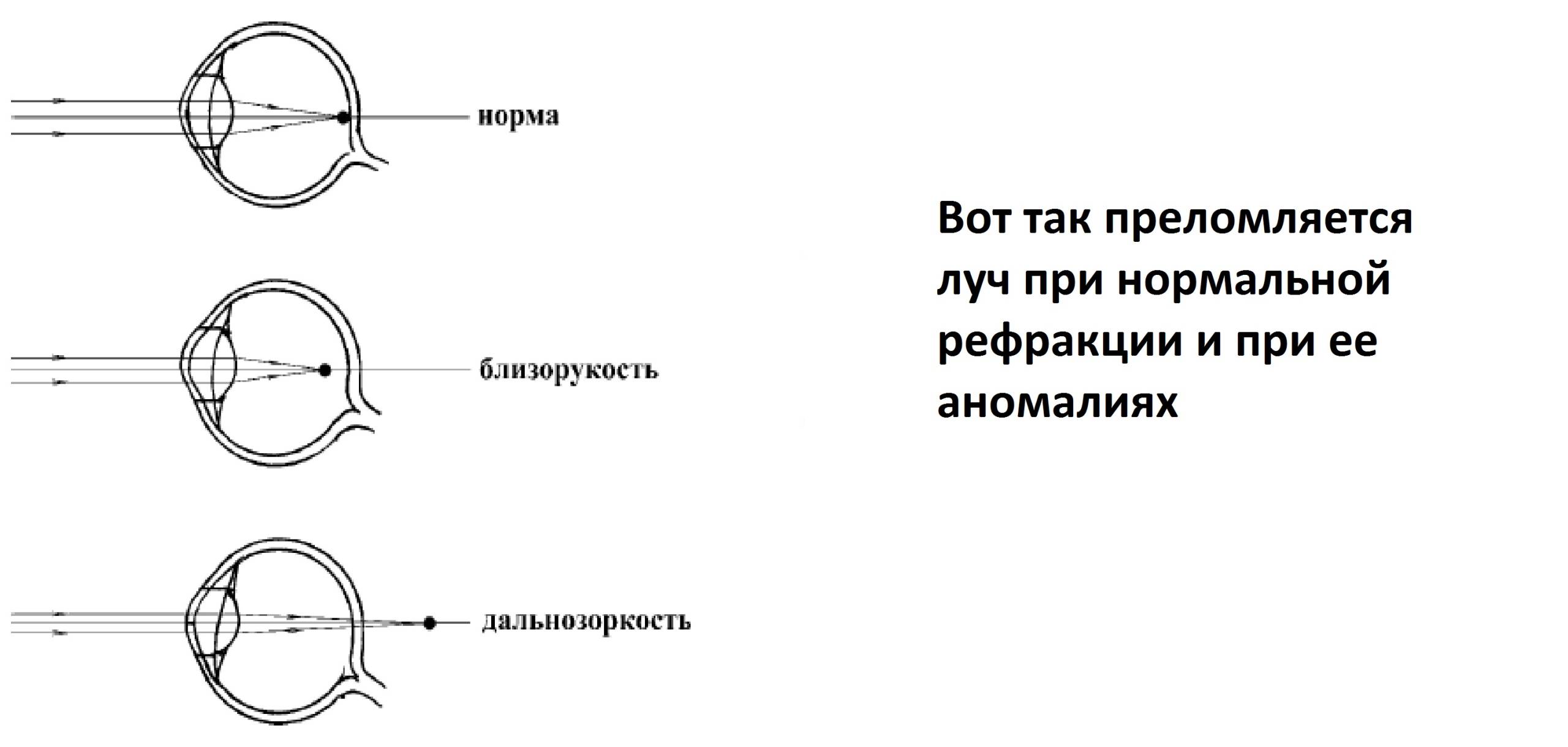 Рефракция глаза