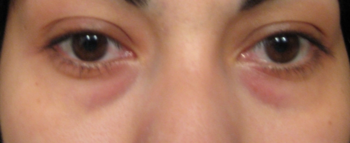 Отеки под глазами