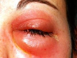 Абсцесс вокруг глаза