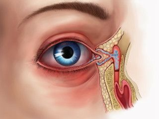 Дакриоцистит 2