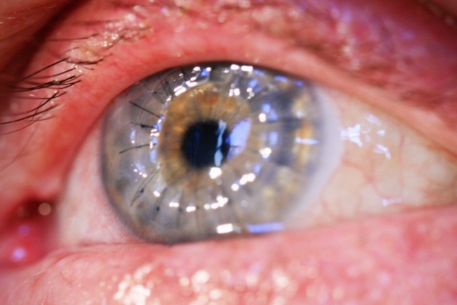 Дистрофия 5