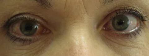 покраснение одного глаза