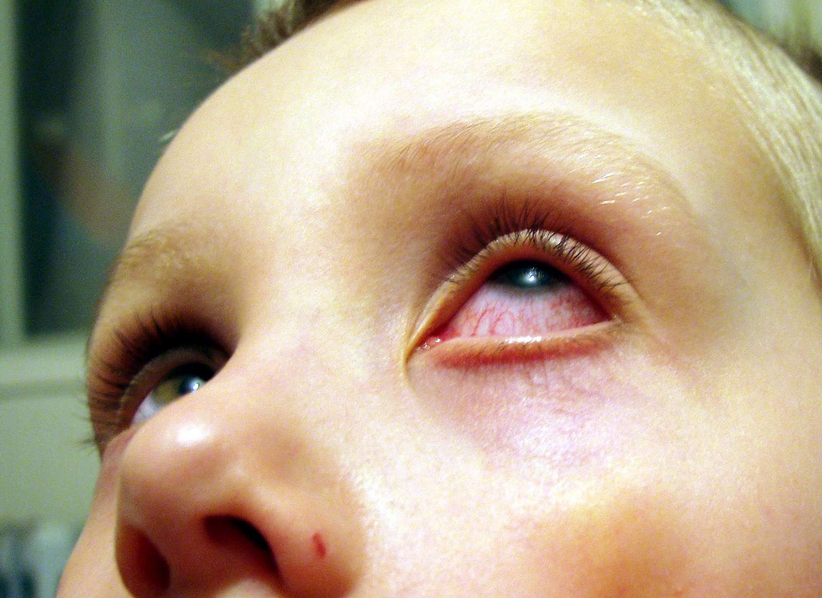 покраснение конъюнктивы