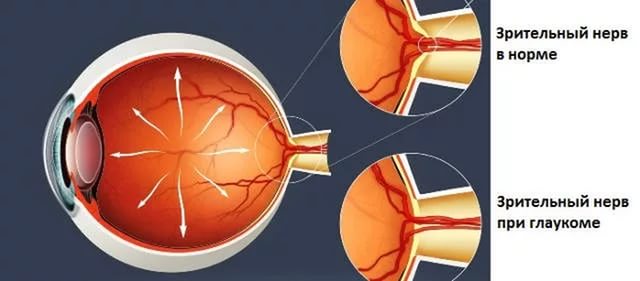 сравнение зрительного нерва нормального и при глаукоме