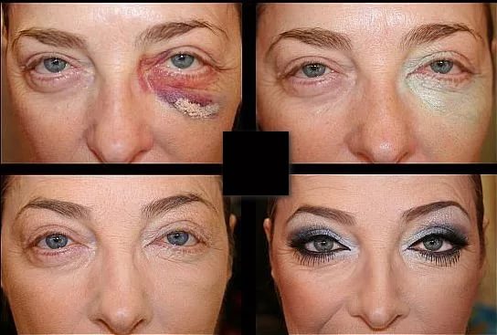 маскировка синяка