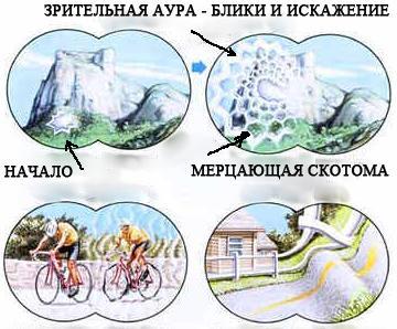 скотома 2