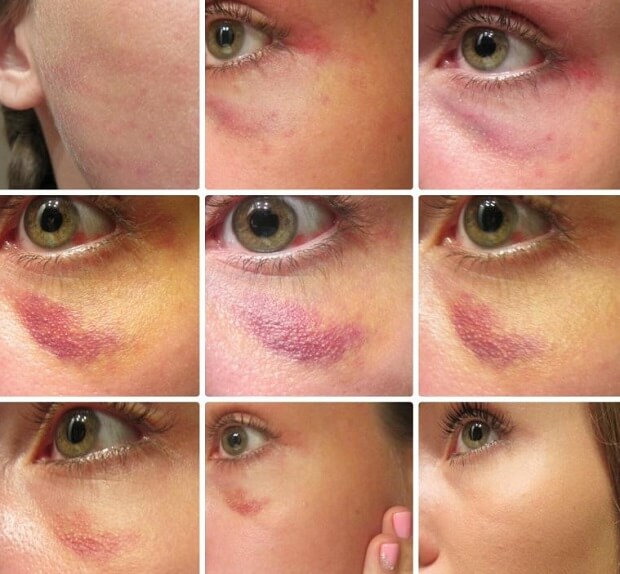 маскировка синяка